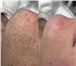 Фото в Красота и здоровье Косметические услуги Глубокое очищение кожи лица, устранение акне в Москве 1 500